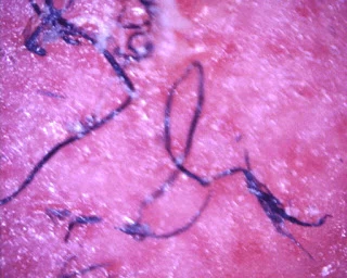 Morgellons σε ιατρικές μάσκες και δοκιμές PCR για Covid 19